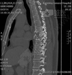 腰椎钉棒固定手术视频,腰椎钉棒固定手术操作步骤解析